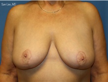 Breast Lift After Photo by Samuel Lien, MD; Everett, WA - Case 48644
