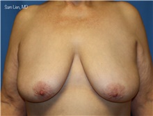 Breast Lift Before Photo by Samuel Lien, MD; Everett, WA - Case 48644