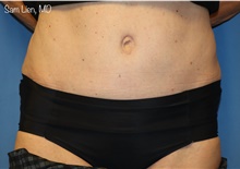 Tummy Tuck After Photo by Samuel Lien, MD; Everett, WA - Case 48723