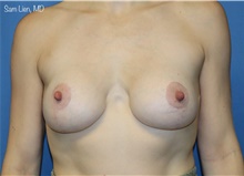 Breast Augmentation After Photo by Samuel Lien, MD; Everett, WA - Case 49254