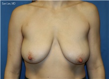 Breast Augmentation Before Photo by Samuel Lien, MD; Everett, WA - Case 49254