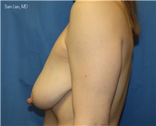 Breast Augmentation Before Photo by Samuel Lien, MD; Everett, WA - Case 49254