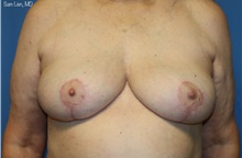 Breast Implant Removal After Photo by Samuel Lien, MD; Everett, WA - Case 49255