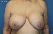 Breast Implant Removal Before Photo by Samuel Lien, MD; Everett, WA - Case 49255