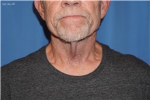 Neck Lift Before Photo by Samuel Lien, MD; ,  - Case 50374