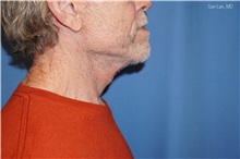 Neck Lift After Photo by Samuel Lien, MD; ,  - Case 50374