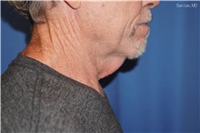 Neck Lift Before Photo by Samuel Lien, MD; ,  - Case 50374
