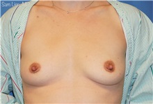 Breast Augmentation Before Photo by Samuel Lien, MD; Everett, WA - Case 50582