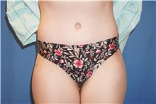 Tummy Tuck After Photo by Samuel Lien, MD; Everett, WA - Case 50770