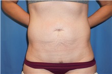 Tummy Tuck Before Photo by Samuel Lien, MD; Everett, WA - Case 50770