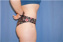 Tummy Tuck After Photo by Samuel Lien, MD; Everett, WA - Case 50770