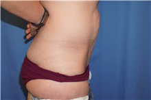 Tummy Tuck Before Photo by Samuel Lien, MD; Everett, WA - Case 50770