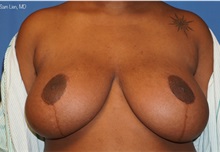 Breast Reduction After Photo by Samuel Lien, MD; Everett, WA - Case 51371