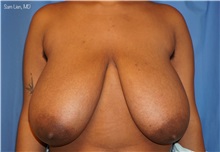 Breast Reduction Before Photo by Samuel Lien, MD; Everett, WA - Case 51371