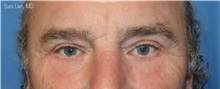 Eyelid Surgery After Photo by Samuel Lien, MD; Everett, WA - Case 49323