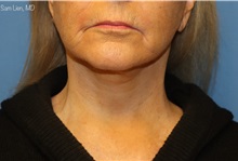 Neck Lift After Photo by Samuel Lien, MD; Everett, WA - Case 49399