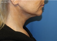 Neck Lift After Photo by Samuel Lien, MD; Everett, WA - Case 49399