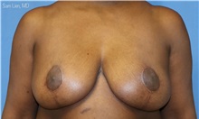 Breast Reduction After Photo by Samuel Lien, MD; Everett, WA - Case 49857