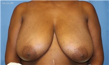 Breast Reduction Before Photo by Samuel Lien, MD; Everett, WA - Case 49857