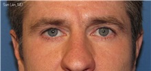 Eyelid Surgery After Photo by Samuel Lien, MD; Everett, WA - Case 49856