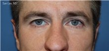 Eyelid Surgery Before Photo by Samuel Lien, MD; Everett, WA - Case 49856