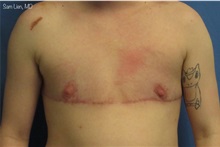Transmasculine Top Surgery After Photo by Samuel Lien, MD; Everett, WA - Case 49859 Transmasculine Top Surgery After Photo by Samuel Lien, MD; Everett, WA - Case 49859