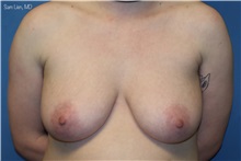 Transmasculine Top Surgery Before Photo by Samuel Lien, MD; Everett, WA - Case 49859 Transmasculine Top Surgery Before Photo by Samuel Lien, MD; Everett, WA - Case 49859