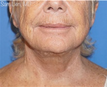 Facelift After Photo by Samuel Lien, MD; Everett, WA - Case 50092 Facelift After Photo by Samuel Lien, MD; Everett, WA - Case 50092