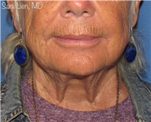 Facelift Before Photo by Samuel Lien, MD; Everett, WA - Case 50092 Facelift Before Photo by Samuel Lien, MD; Everett, WA - Case 50092