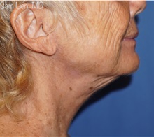 Facelift After Photo by Samuel Lien, MD; Everett, WA - Case 50092
