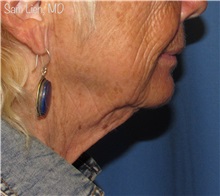 Facelift Before Photo by Samuel Lien, MD; Everett, WA - Case 50092