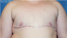 Transmasculine Top Surgery After Photo by Samuel Lien, MD; Everett, WA - Case 50091 Transmasculine Top Surgery After Photo by Samuel Lien, MD; Everett, WA - Case 50091