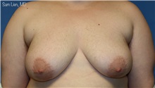 Transmasculine Top Surgery Before Photo by Samuel Lien, MD; Everett, WA - Case 50091 Transmasculine Top Surgery Before Photo by Samuel Lien, MD; Everett, WA - Case 50091