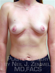 Breast Augmentation Before Photo by Neil Zemmel, MD, FACS; Richmond, VA - Case 29530