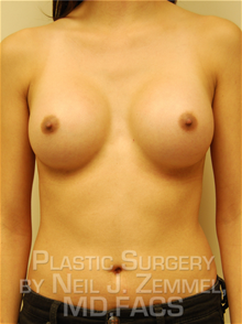 Breast Augmentation After Photo by Neil Zemmel, MD, FACS; Richmond, VA - Case 29532