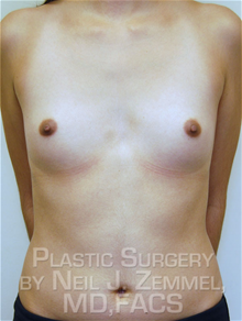 Breast Augmentation Before Photo by Neil Zemmel, MD, FACS; Richmond, VA - Case 29532