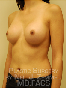 Breast Augmentation After Photo by Neil Zemmel, MD, FACS; Richmond, VA - Case 29532
