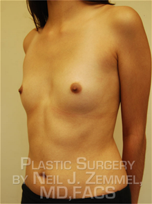 Breast Augmentation Before Photo by Neil Zemmel, MD, FACS; Richmond, VA - Case 29532