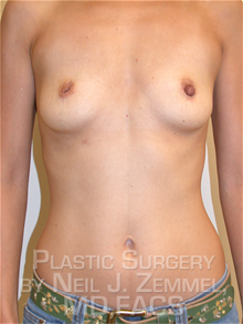 Breast Augmentation Before Photo by Neil Zemmel, MD, FACS; Richmond, VA - Case 29533