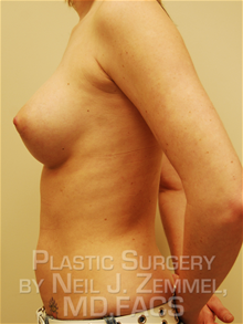 Breast Augmentation After Photo by Neil Zemmel, MD, FACS; Richmond, VA - Case 29535