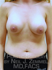 Breast Augmentation After Photo by Neil Zemmel, MD, FACS; Richmond, VA - Case 29537