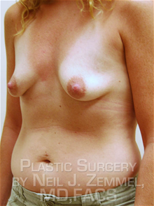 Breast Augmentation Before Photo by Neil Zemmel, MD, FACS; Richmond, VA - Case 29537