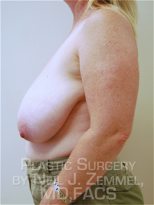 Breast Reduction Before Photo by Neil Zemmel, MD, FACS; Richmond, VA - Case 29540