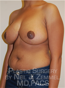 Breast Reduction After Photo by Neil Zemmel, MD, FACS; Richmond, VA - Case 29541