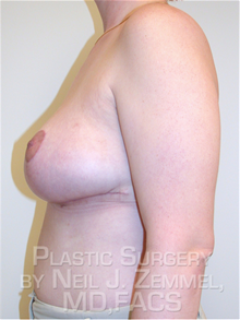 Breast Reduction After Photo by Neil Zemmel, MD, FACS; Richmond, VA - Case 29542