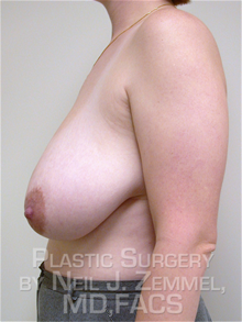 Breast Reduction Before Photo by Neil Zemmel, MD, FACS; Richmond, VA - Case 29542