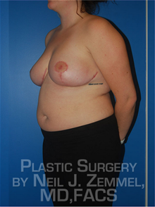 Breast Reduction After Photo by Neil Zemmel, MD, FACS; Richmond, VA - Case 29544