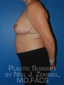 Breast Reduction After Photo by Neil Zemmel, MD, FACS; Richmond, VA - Case 29544