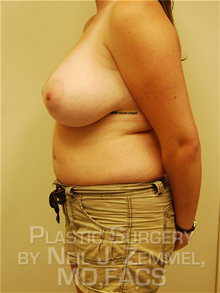 Breast Reduction Before Photo by Neil Zemmel, MD, FACS; Richmond, VA - Case 29544