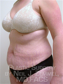 Tummy Tuck Before Photo by Neil Zemmel, MD, FACS; Richmond, VA - Case 29545